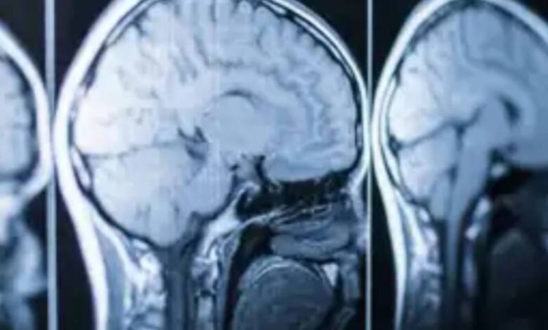 Nuevo estudio investigará implantes cerebrales con ultrasonido