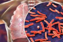 El CONICET desarrolló un método rápido, económico y sin cultivo para diagnosticar tuberculosis