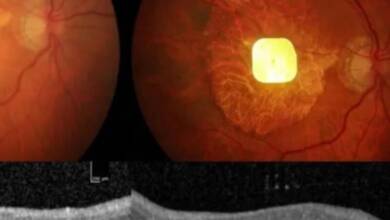 Un chip implantado en el ojo devuelve la vista a 32 personas
