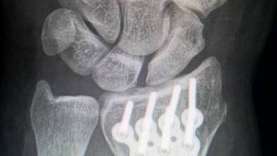 Una terapia con células madre reduce las fracturas en niños con huesos frágiles