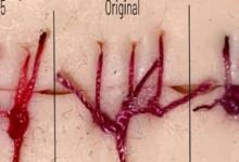 Una estudiante creó suturas que cambian de color ante infecciones