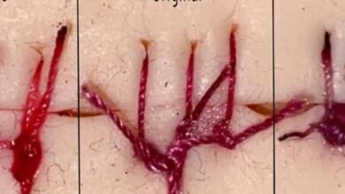 Una estudiante creó suturas que cambian de color ante infecciones