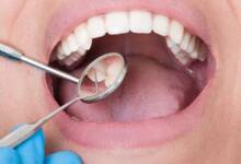 Encontraron una molécula que elimina la placa que causa caries